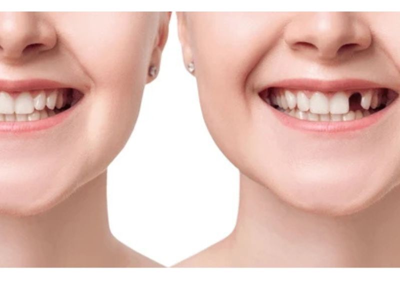 🦷 Dental Implants: The Permanent Solution to Missing Teeth