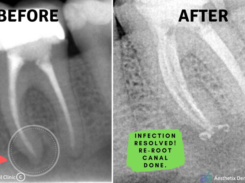🦷 Root Canal Treatment: Save Your Natural Tooth Without the Pain