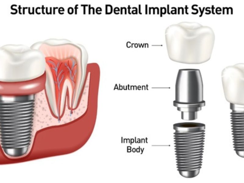 🦷 Dental Implants: The Permanent Solution to Missing Teeth
