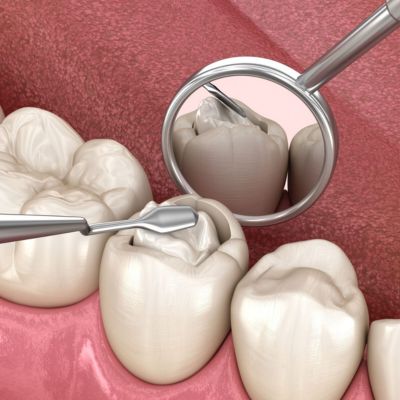 Dental Fillings