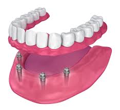 Dental implants