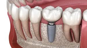 Dental implants