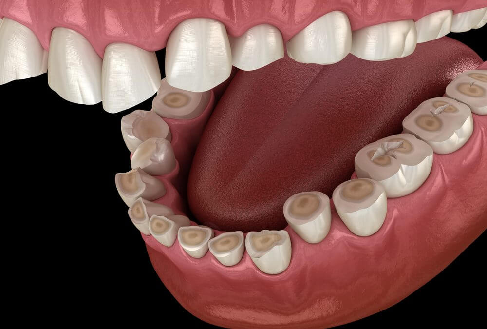 enamel erosion dental illustration