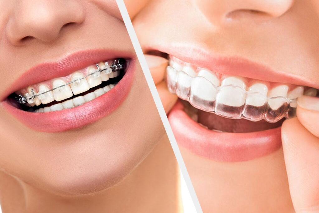 Invisalign vs Braces: Which Is Right for You?