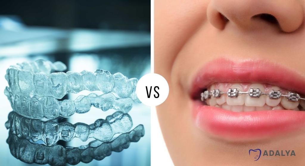 Invisalign vs Braces: Which Is Right for You?