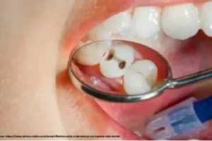 Baby bottle tooth decay