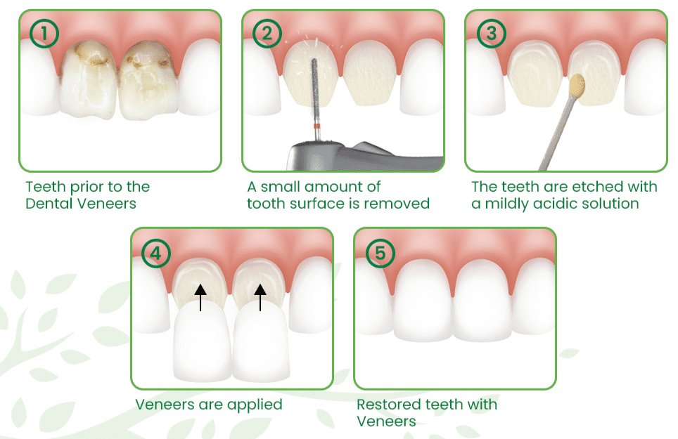 Dental procedure steps for veneer placement in Noida