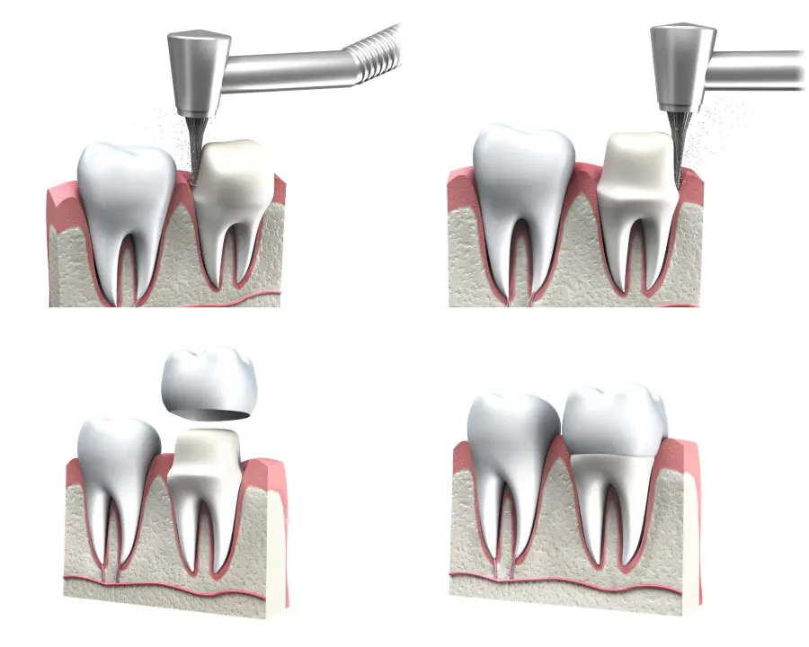 Dental procedure steps for crown placement in Noida