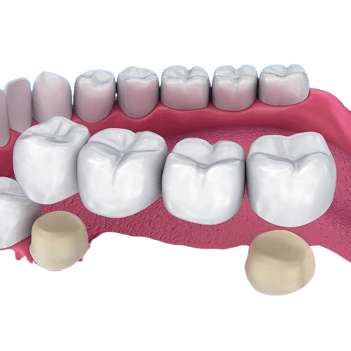 Dental Crowns