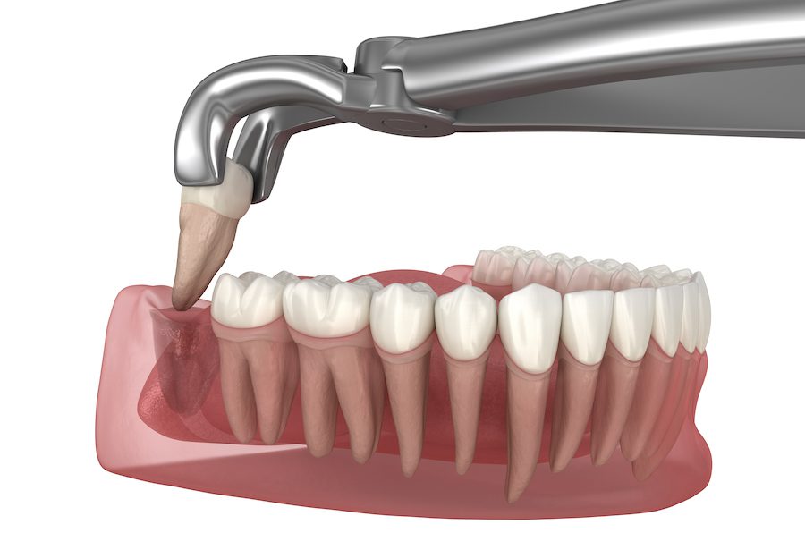 tooth extraction