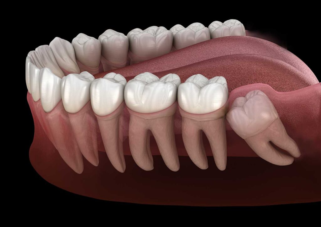wisdom tooth pain