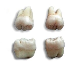 wisdom tooth pain