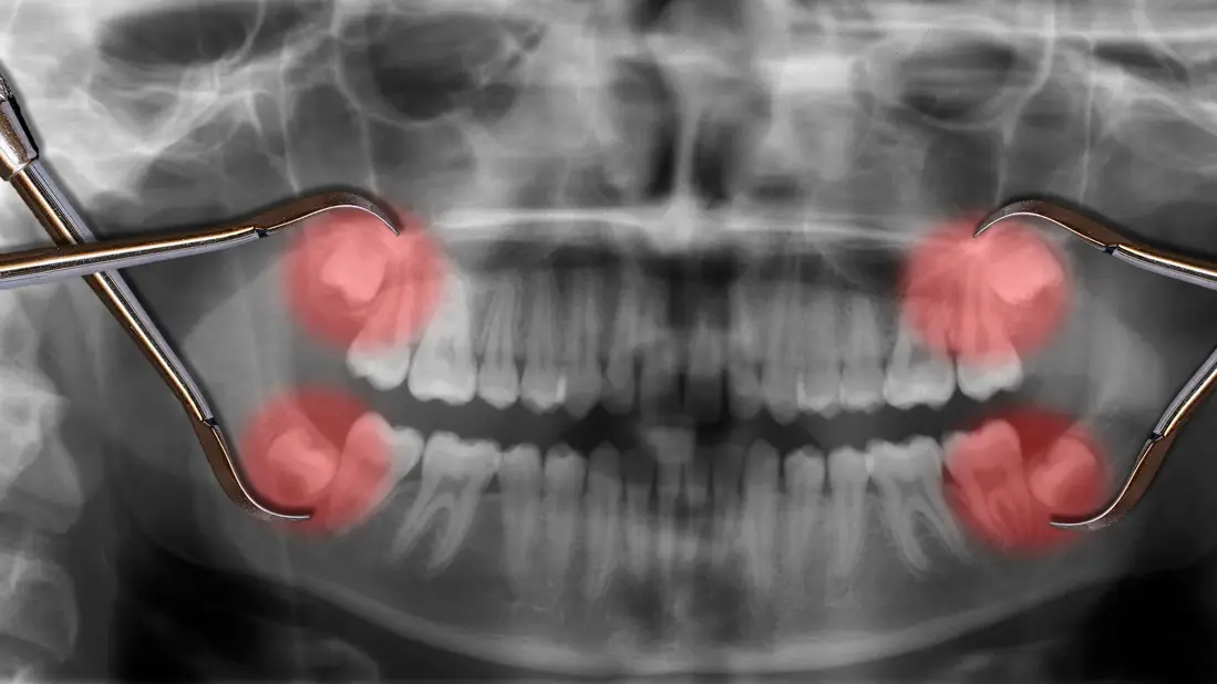 opg of wisdom tooth pain