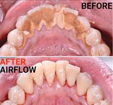 teeth cleaning
