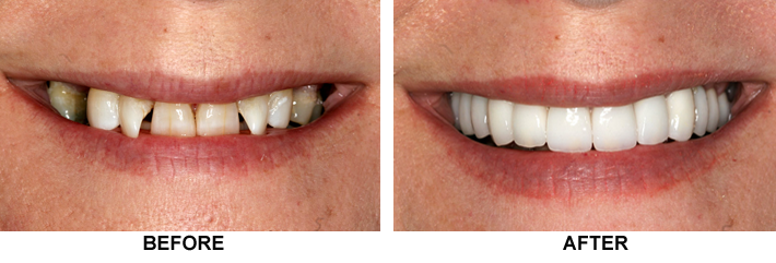 Veneers vs Crowns