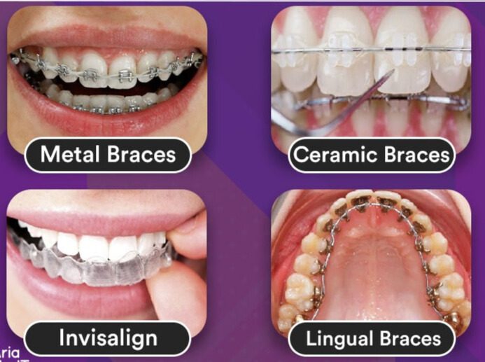 braces and aligners