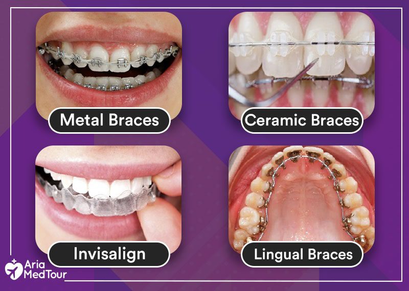 Braces and Aligners