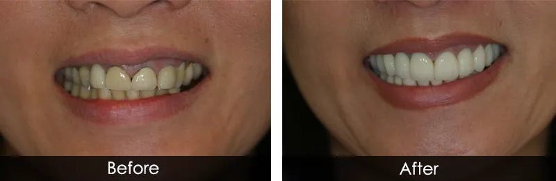 Teeth before and after porcelain veneers treatment at Family Dental Clinic Noida