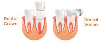 Chart showing visual differences between dental veneer and dental crown
