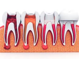 Root Canal Treatment