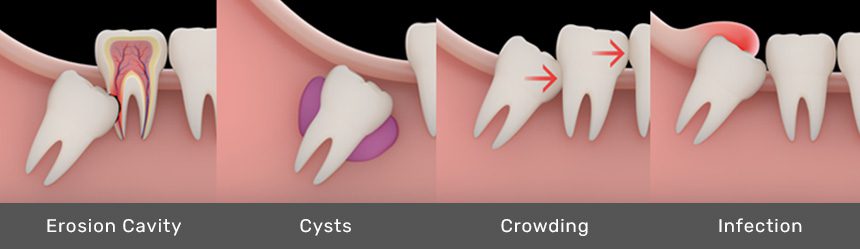 wisdom tooth pain and infection