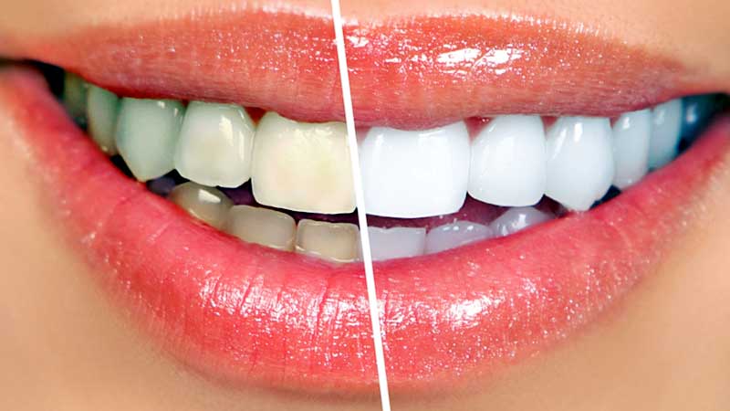 teeth whitening