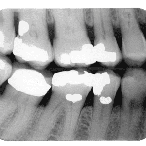 7 Signs You Need a Dental Crown