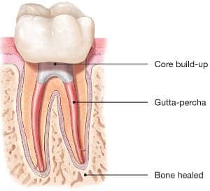 7 Signs You Need a Dental Crown