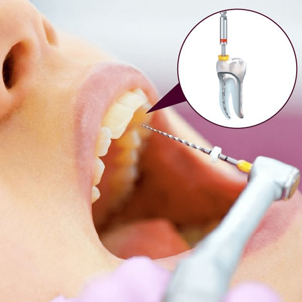 Painless root canal treatment in Noida – Family Dental Clinic