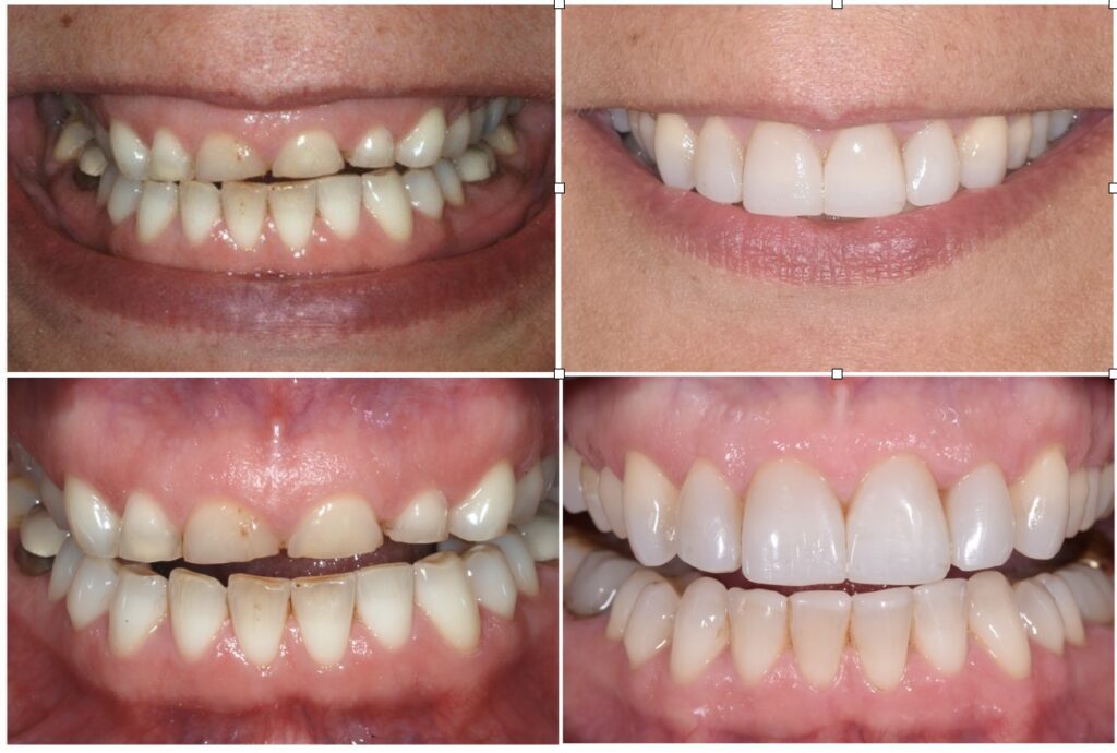 7 Signs You Need a Dental Crown