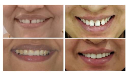 Invisalign and braces treatment in Noida – best dental clinic