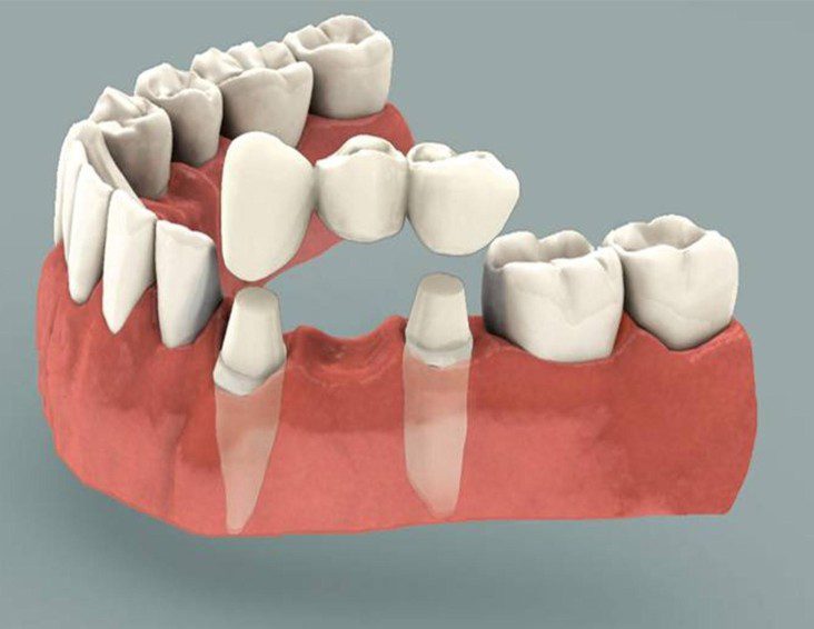 7 Signs You Need a Dental Crown