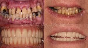 Smile Makeover Noida – Cosmetic Dentist Results