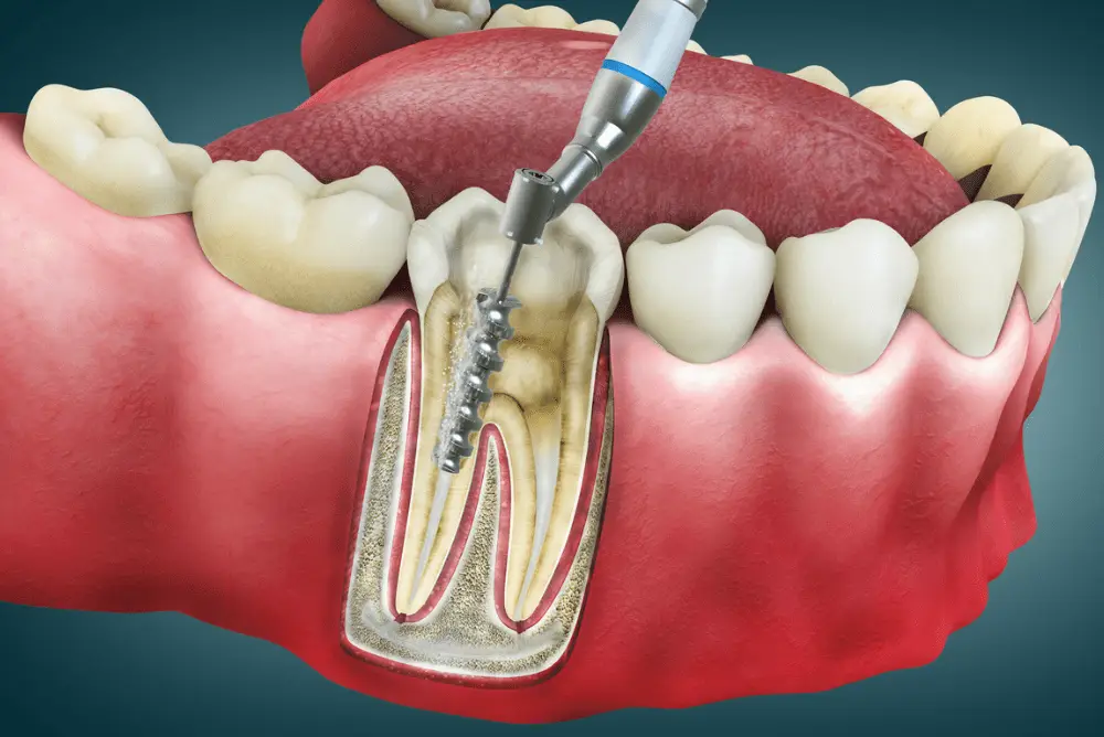 Root canal procedure diagram showing infected pulp removal using rotary file at Family Dental Clinic, dentist in Sector 70 Noida