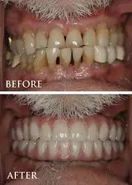 Before and after gum disease treatment results showing improved periodontal health at Family Dental Clinic Noida