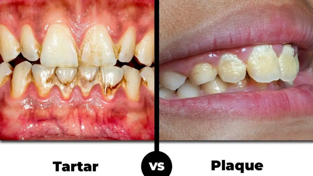 plaque vs tartar