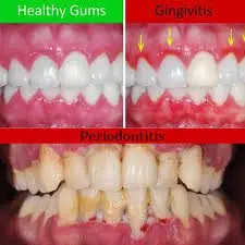 Three stages of gum disease from gingivitis to advanced periodontitis diagram for Noida patients