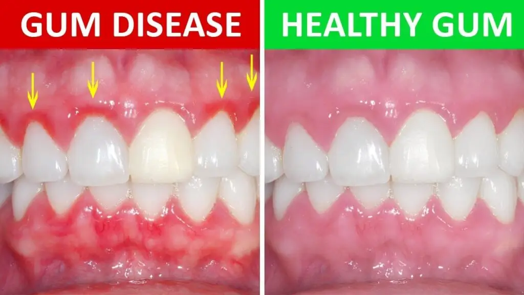 Gum disease in Noida showing comparison of healthy gums vs periodontal disease at Family Dental Clinic