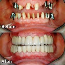 before and after dental implant treatment in noida