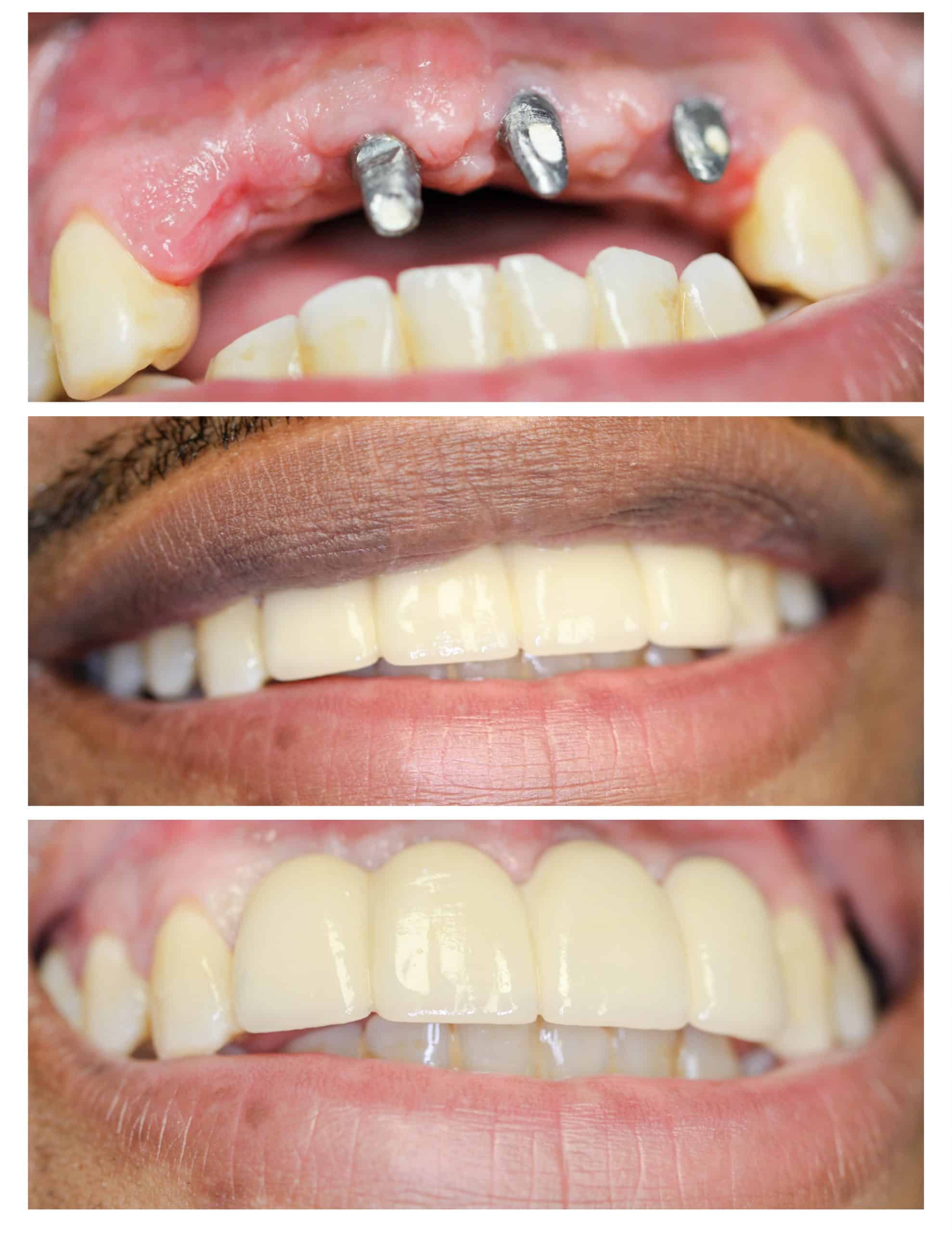 Before and after dental implant treatment in Sector 70 Noida
