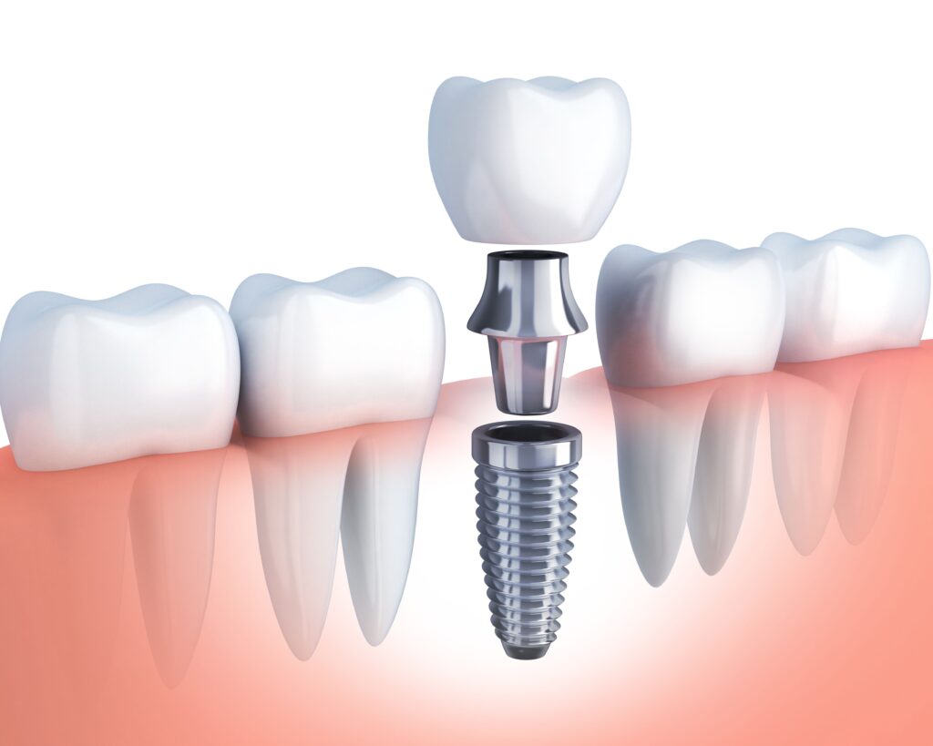 Dental Implants in Sector 70 Noida